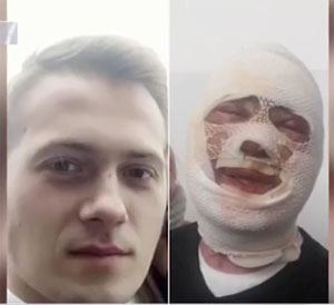 Підозрюваним у вихлюпуванні кислоти в обличчя ужгородцю називають 20-річного ревнивця із Тячівщини