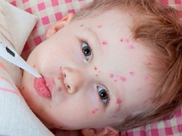 Через кір у школі в Горонді на Мукачівщині введено карантин. 1 дитина шпиталізована, ще 16 – лікуються амбулаторно