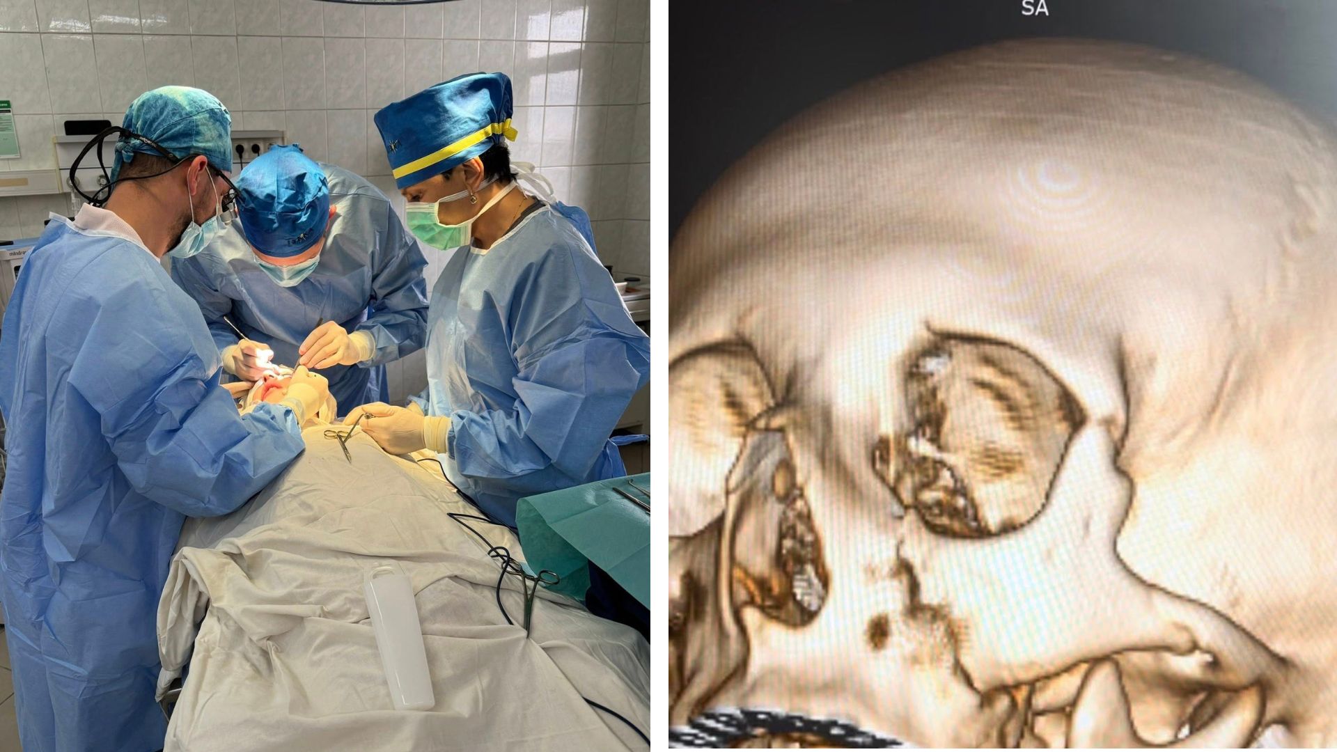 Закарпатські лікарі відновили обличчя 14-річного хлопця після серйозного перелому (ФОТО)