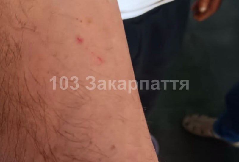 На Тячівщині чоловіка госпіталізували після ймовірного укусу змії (ФОТО)